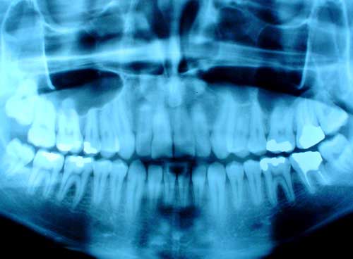 X-ray of teeth